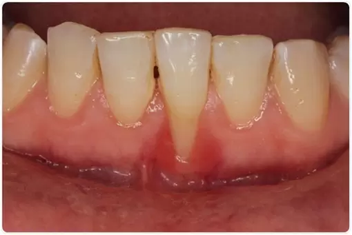 Periodontitis