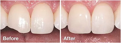 cosmetic-bonding-before-after