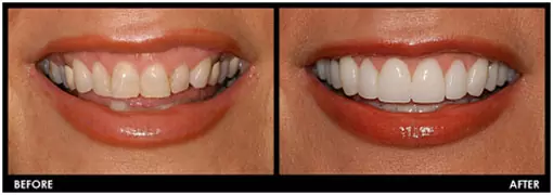 Porcelain Veneers