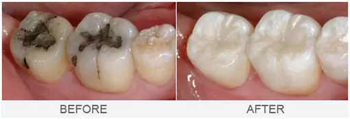 White Fillings
