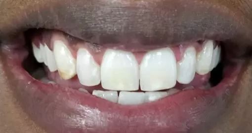 teeth whitening after 510x270