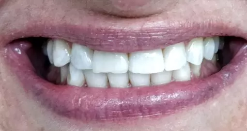 teeth whitening after case3 510x270