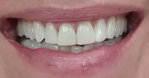 teeth whitening after case4 510x270