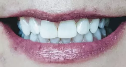 teeth whitening aftercase2 510x270