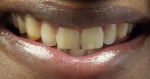 teeth whitening before 510x270