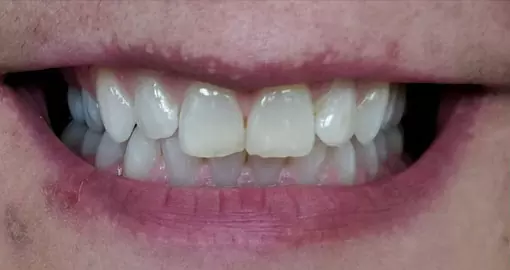 teeth whitening before case2 510x270