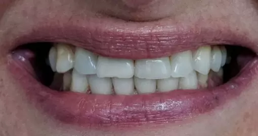 teeth whitening before case3 510x270