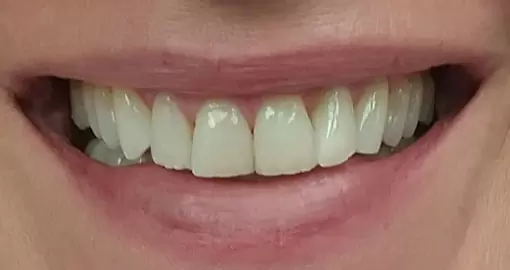 teeth whitening before case4 510x270