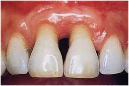 Gum Disease